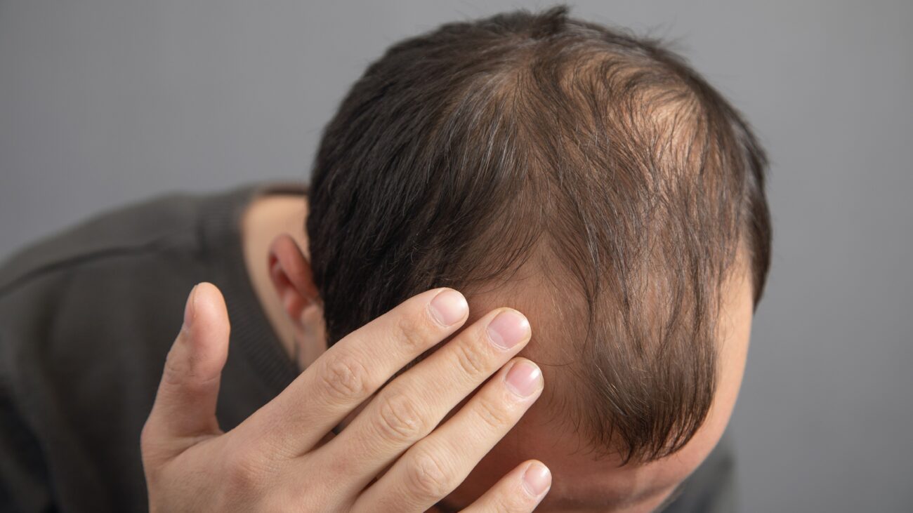 DHT: Its Role in Muscle Building vs. Hair Loss 2 Muscle Building